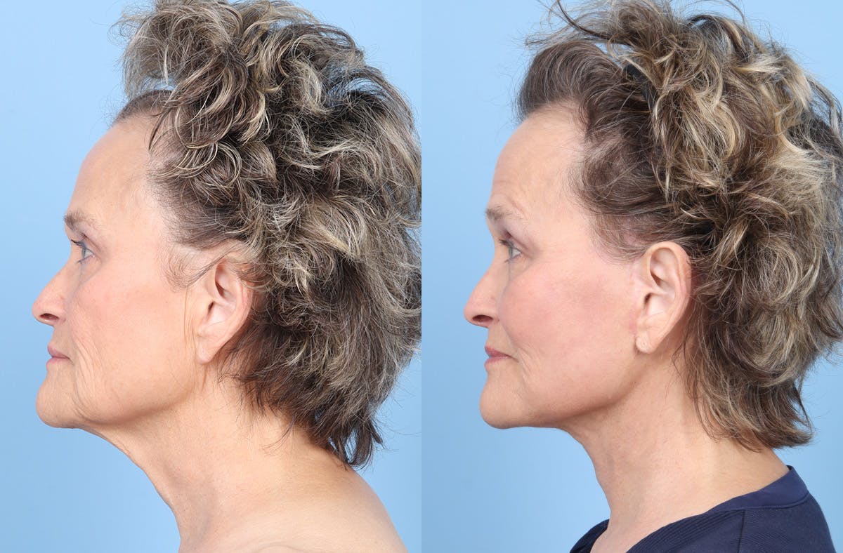 Midface Lift Before & After Gallery - Patient 306535 - Image 5