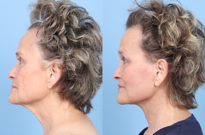 Neck Lift Before & After Gallery - Patient 469464 - Image 1