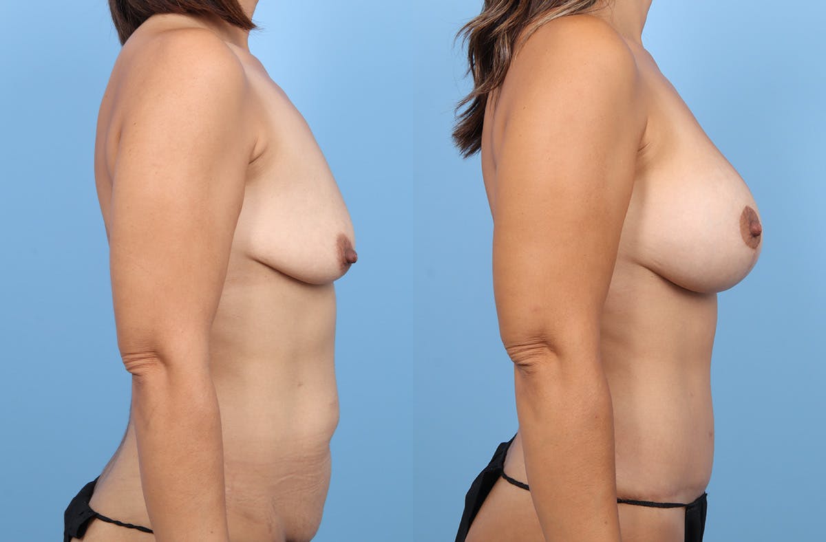 Mommy Makeover Before & After Gallery - Patient 284924 - Image 3