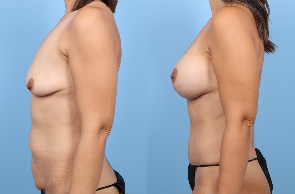 Mommy Makeover Before & After Gallery - Patient 284924 - Image 5