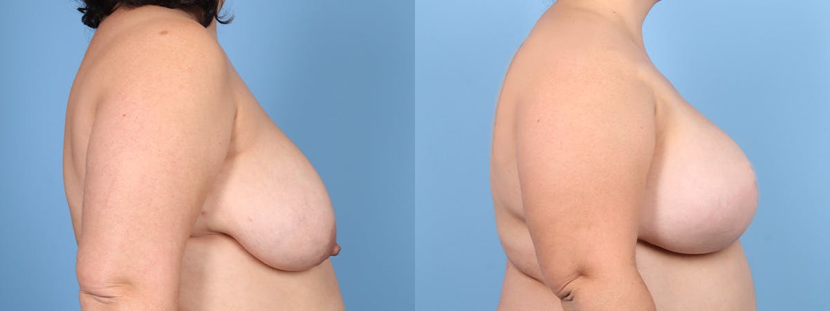DIEP Flap Reconstruction Before & After Gallery - Patient 404940 - Image 3
