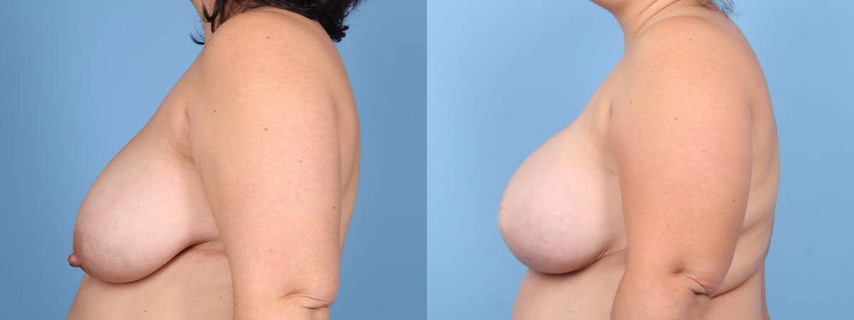 DIEP Flap Reconstruction Before & After Gallery - Patient 404940 - Image 5