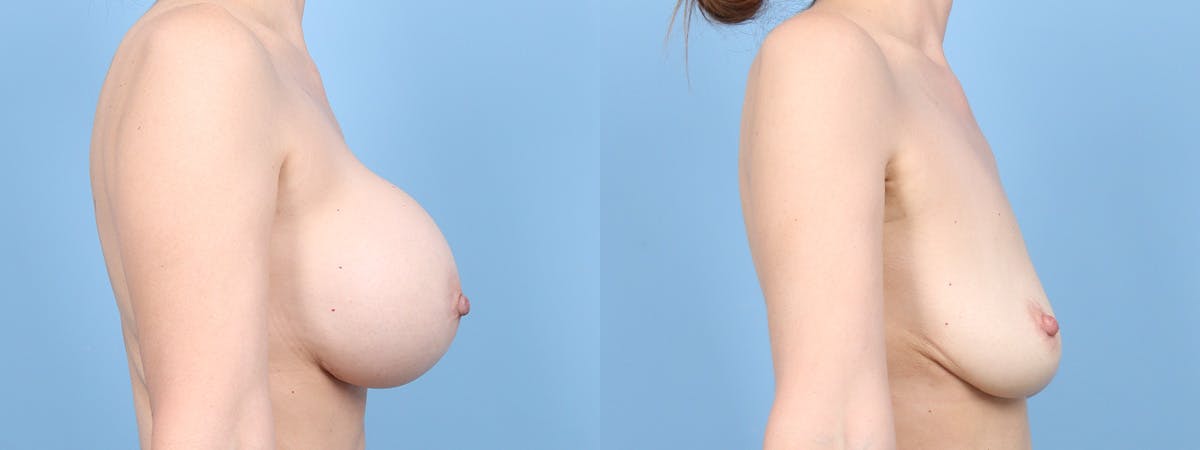 Implant Removal Before & After Gallery - Patient 553418 - Image 3