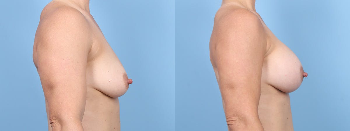 Breast Augmentation Before & After Gallery - Patient 158422 - Image 3
