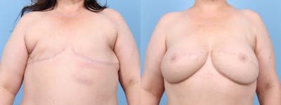 DIEP Flap Reconstruction Before & After Gallery - Patient 256157 - Image 1