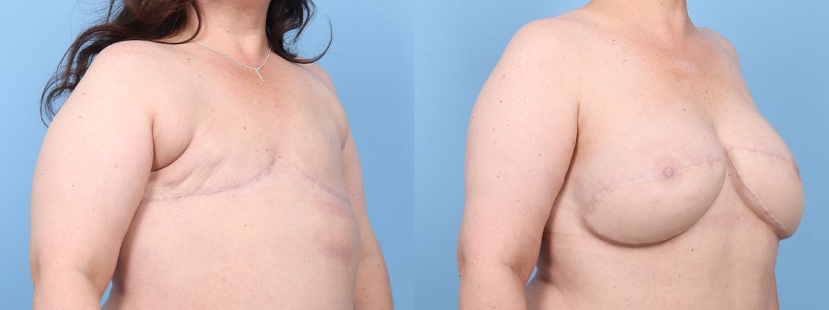 DIEP Flap Reconstruction Before & After Gallery - Patient 256157 - Image 2