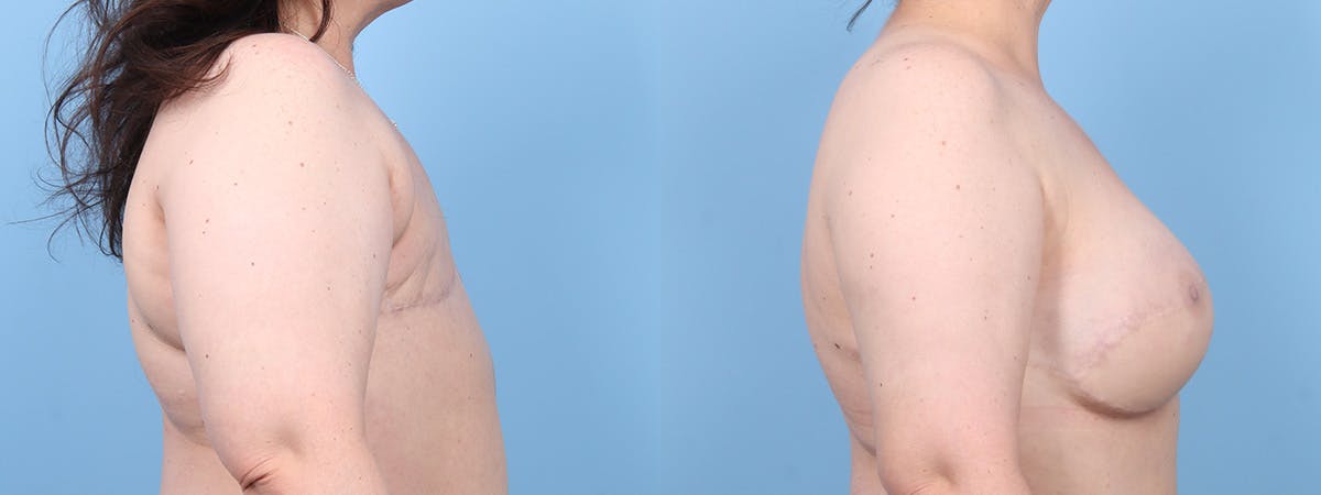 DIEP Flap Reconstruction Before & After Gallery - Patient 256157 - Image 3