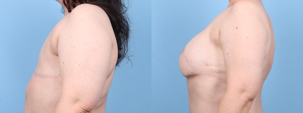 DIEP Flap Reconstruction Before & After Gallery - Patient 256157 - Image 5