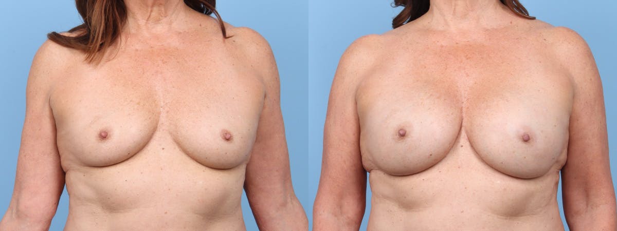 Direct to Implant Reconstruction Before & After Gallery - Patient 154312 - Image 1