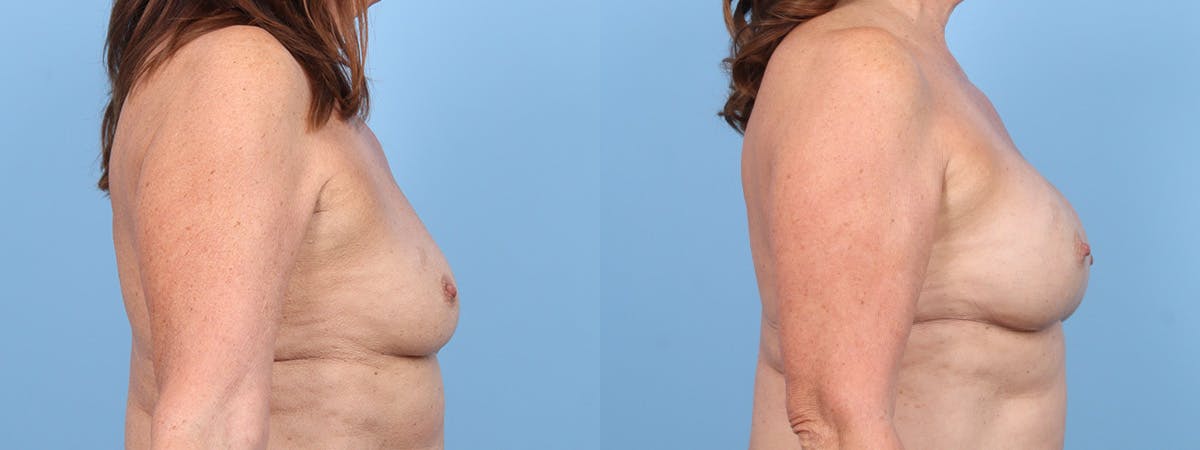 Direct to Implant Reconstruction Before & After Gallery - Patient 154312 - Image 3