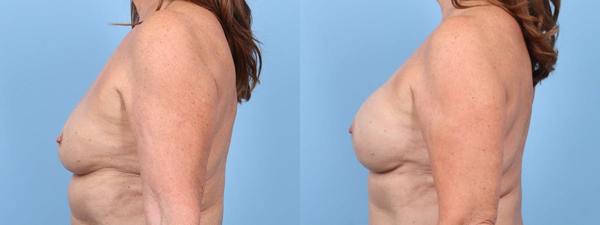 Direct to Implant Reconstruction Before & After Gallery - Patient 154312 - Image 5