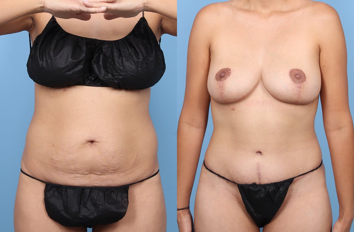 Tummy Tuck Before & After Gallery - Patient 120909 - Image 1