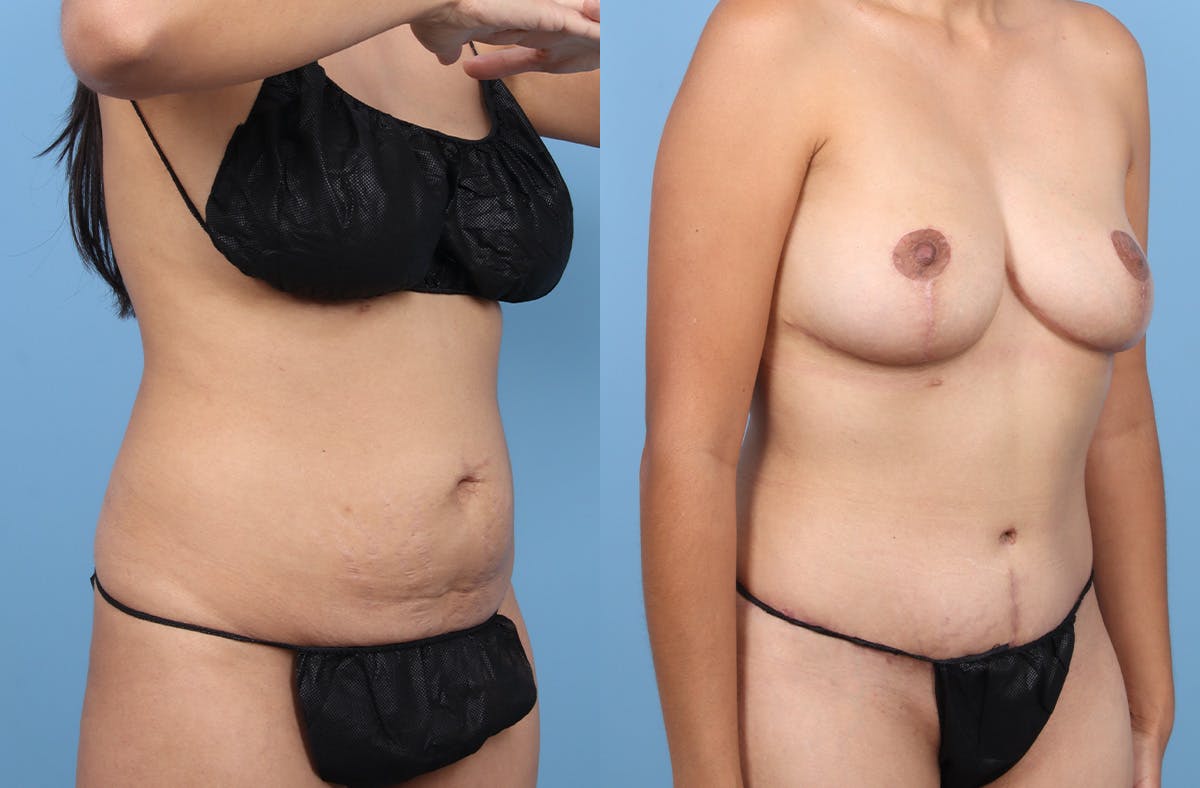 Tummy Tuck Before & After Gallery - Patient 120909 - Image 2