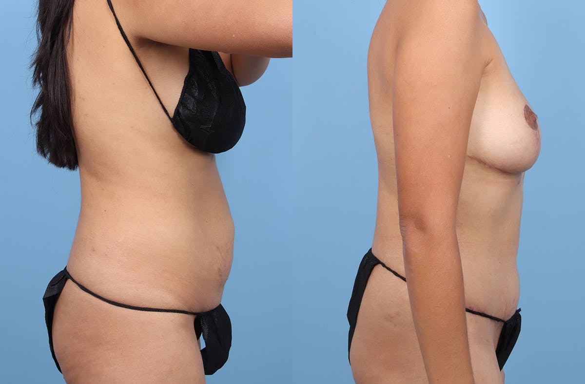 Tummy Tuck Before & After Gallery - Patient 120909 - Image 3
