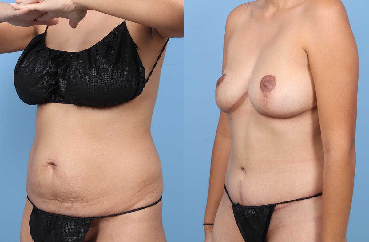 Tummy Tuck Before & After Gallery - Patient 120909 - Image 4