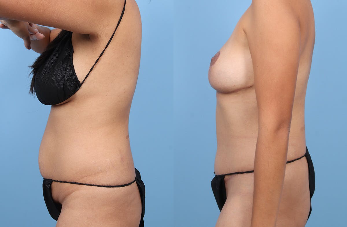 Tummy Tuck Before & After Gallery - Patient 120909 - Image 5
