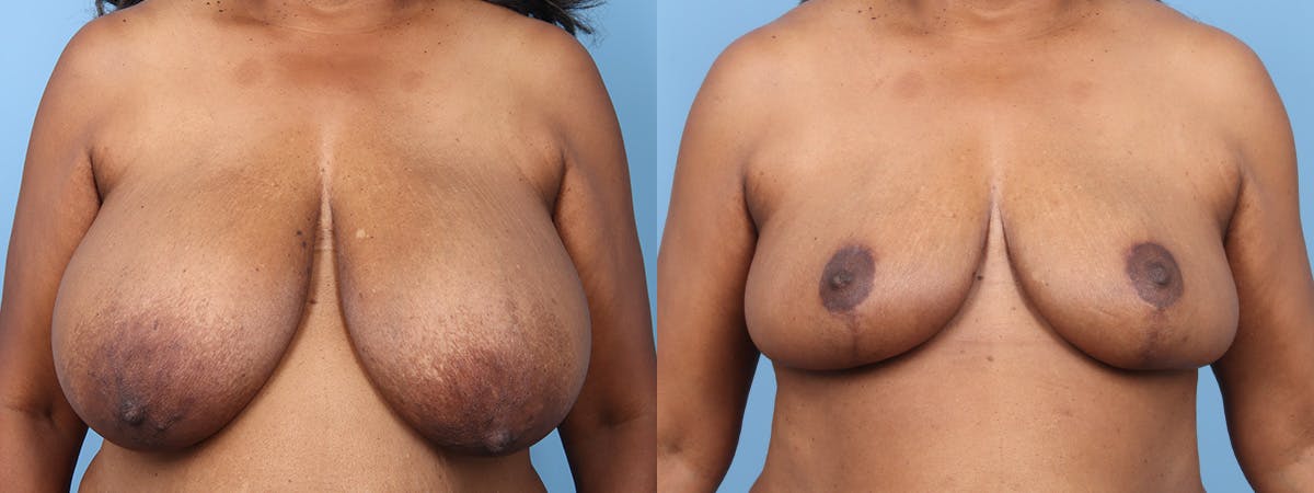 Breast Reduction/Lift Before & After Gallery - Patient 277844 - Image 1