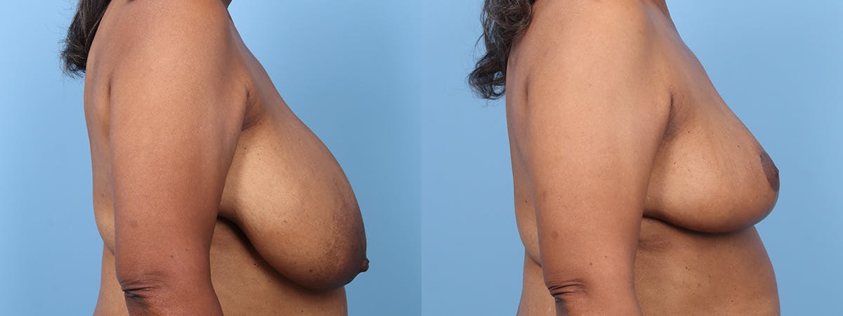 Breast Reduction/Lift Before & After Gallery - Patient 277844 - Image 3