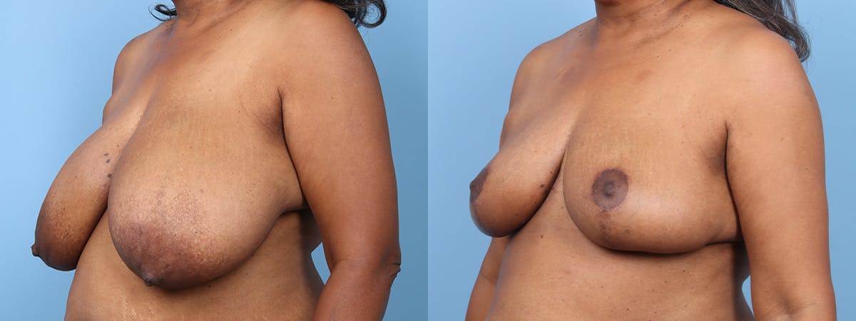 Breast Reduction/Lift Before & After Gallery - Patient 277844 - Image 4