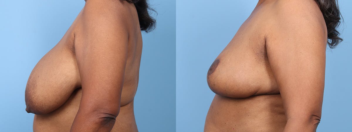 Breast Reduction/Lift Before & After Gallery - Patient 277844 - Image 5