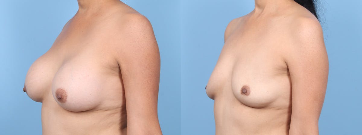 Implant Removal Before & After Gallery - Patient 345205 - Image 4
