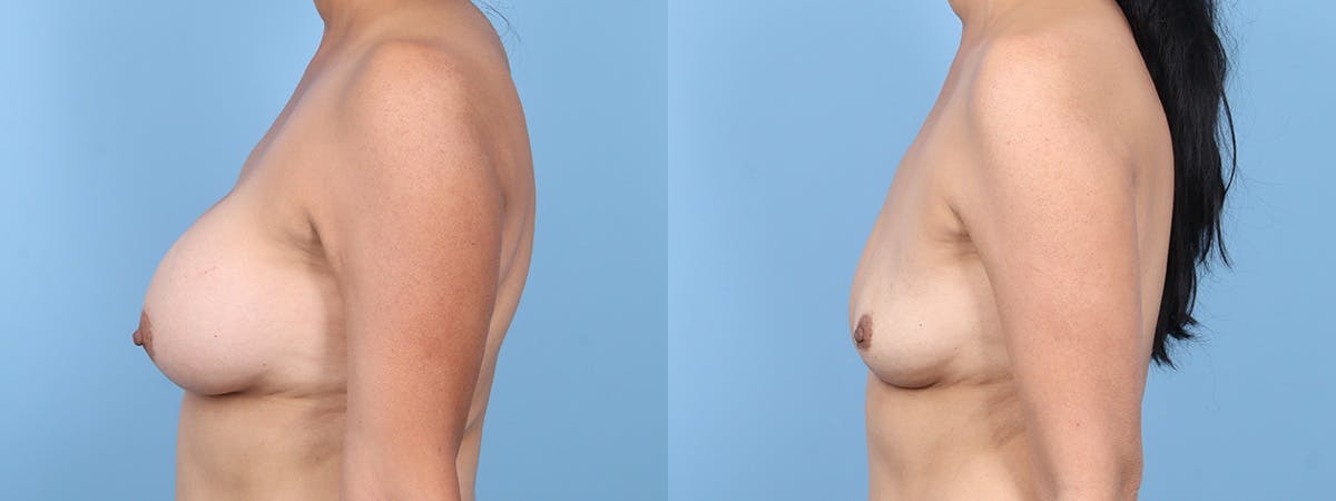 Implant Removal Before & After Gallery - Patient 345205 - Image 5