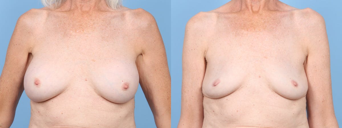Implant Removal Before & After Gallery - Patient 269124 - Image 1