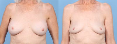 Implant Removal Before & After Gallery - Patient 269124 - Image 1