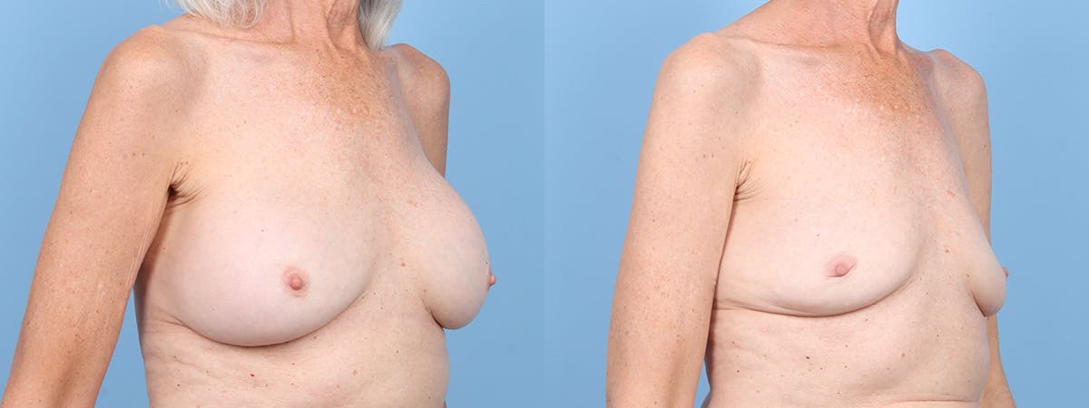 Implant Removal Before & After Gallery - Patient 269124 - Image 2