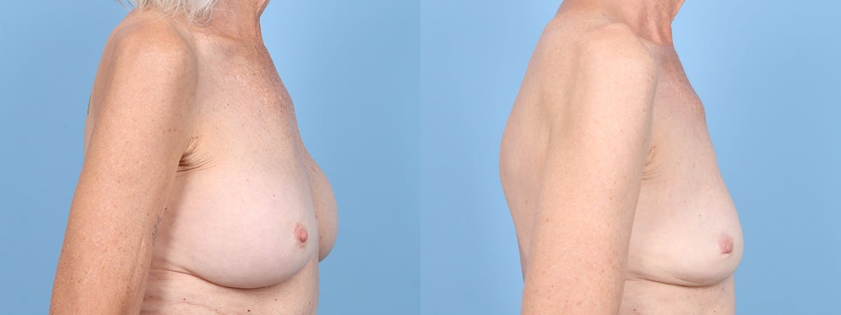 Implant Removal Before & After Gallery - Patient 269124 - Image 3