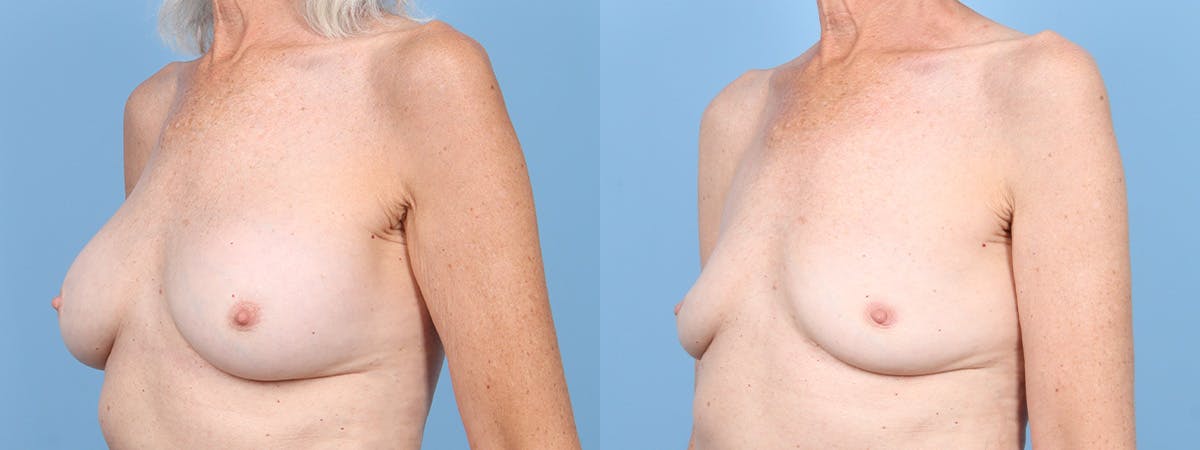 Implant Removal Before & After Gallery - Patient 269124 - Image 4