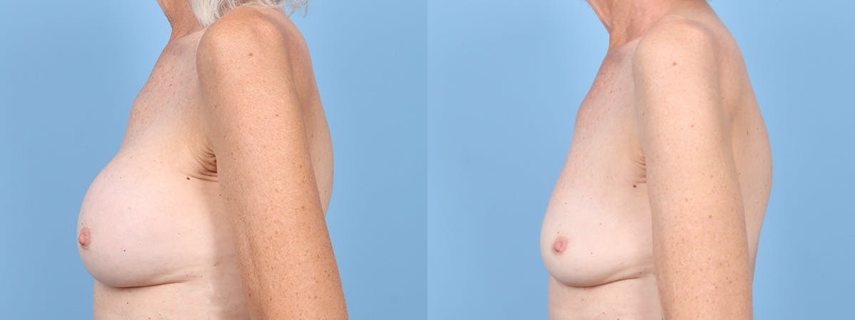 Implant Removal Before & After Gallery - Patient 269124 - Image 5