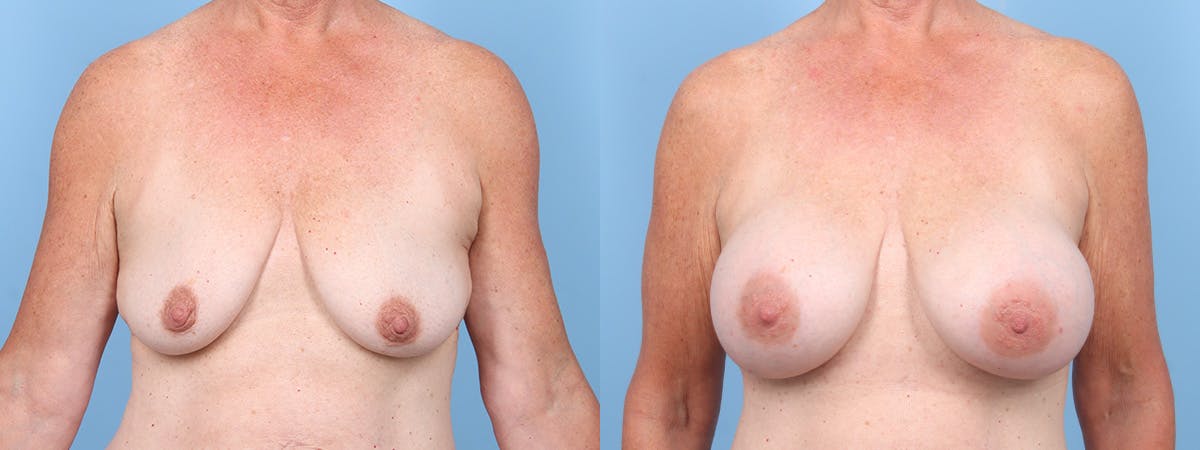 Breast Augmentation Before & After Gallery - Patient 606100 - Image 1