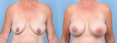Breast Augmentation Before & After Gallery - Patient 606100 - Image 1