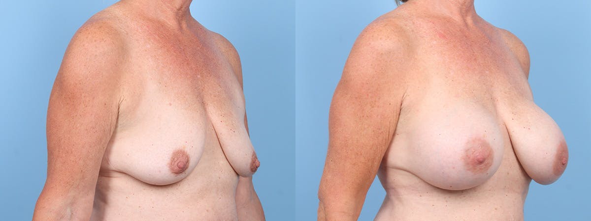 Breast Augmentation Before & After Gallery - Patient 606100 - Image 2