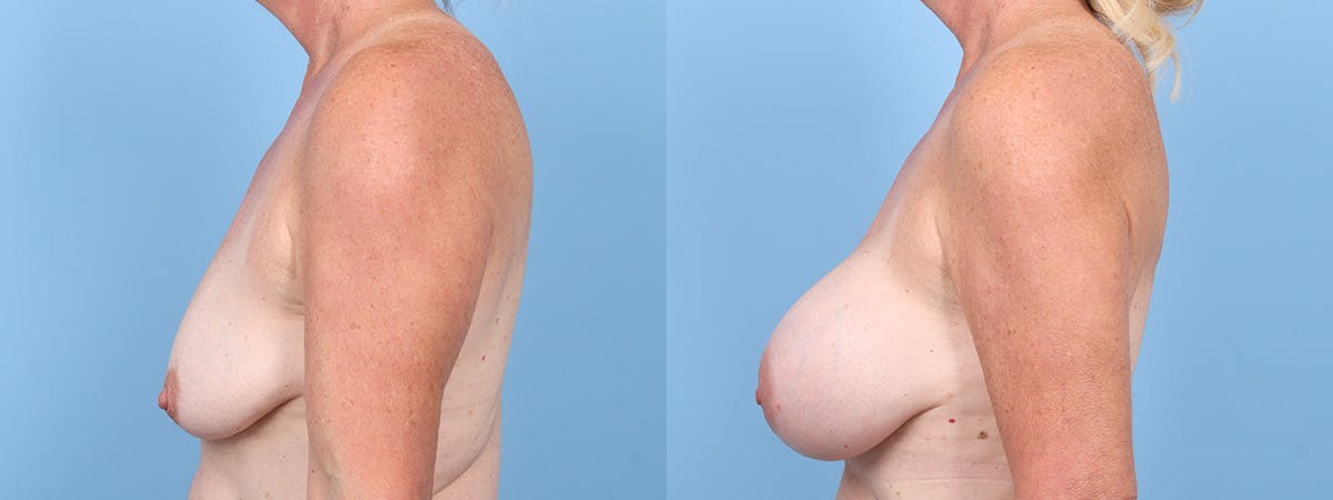 Breast Augmentation Before & After Gallery - Patient 606100 - Image 5