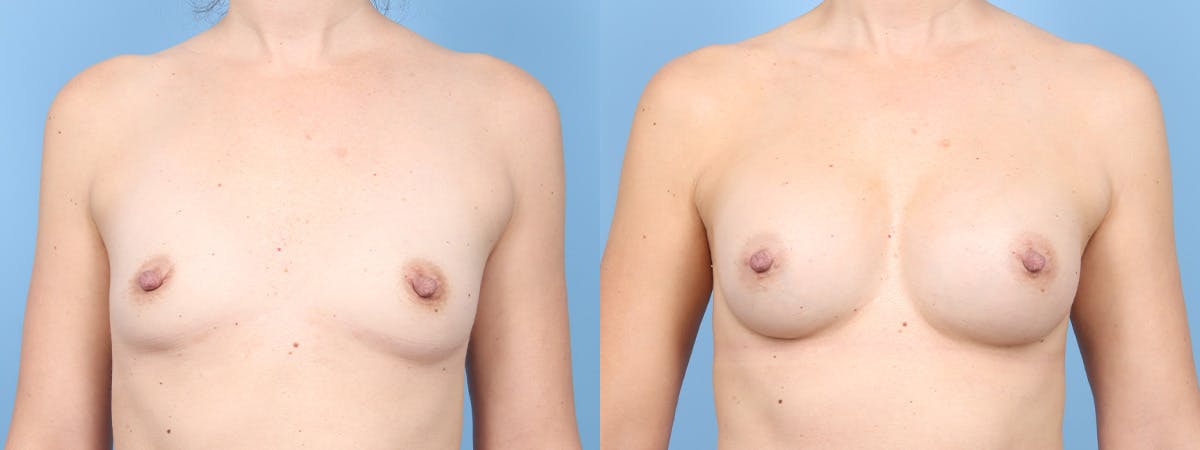Breast Augmentation Before & After Gallery - Patient 203955 - Image 1