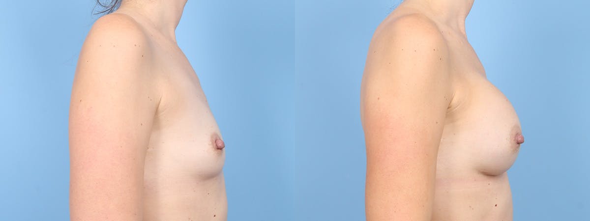 Breast Augmentation Before & After Gallery - Patient 203955 - Image 3