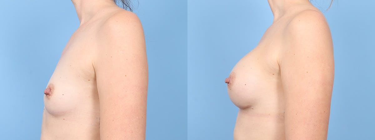 Breast Augmentation Before & After Gallery - Patient 203955 - Image 5