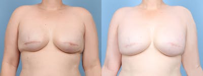 Direct to Implant Reconstruction Before & After Gallery - Patient 309856 - Image 1