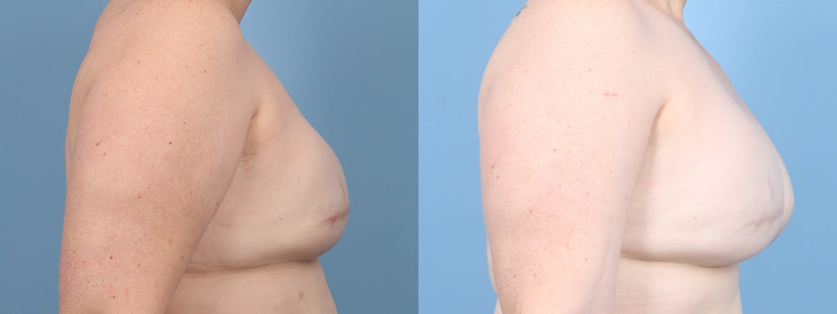 Direct to Implant Reconstruction Before & After Gallery - Patient 309856 - Image 3