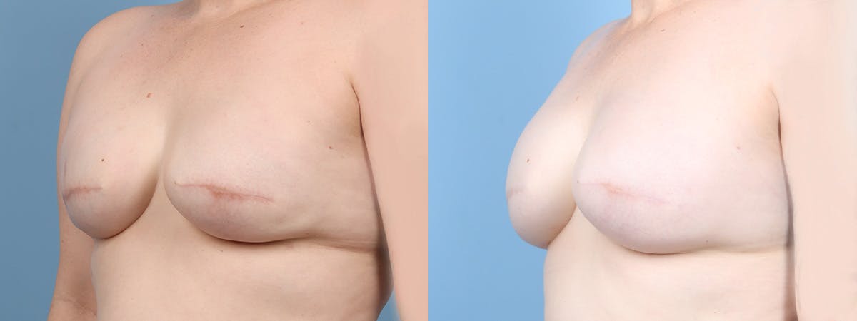 Direct to Implant Reconstruction Before & After Gallery - Patient 309856 - Image 4