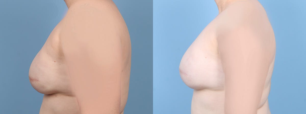 Direct to Implant Reconstruction Before & After Gallery - Patient 309856 - Image 5