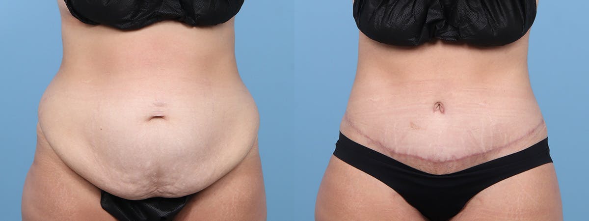 Tummy Tuck Before & After Gallery - Patient 222366 - Image 1