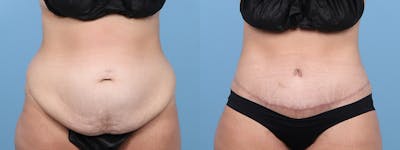 Tummy Tuck Before & After Gallery - Patient 222366 - Image 1