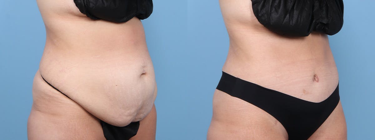 Tummy Tuck Before & After Gallery - Patient 222366 - Image 2