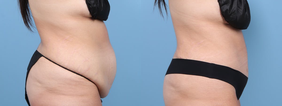 Tummy Tuck Before & After Gallery - Patient 222366 - Image 3