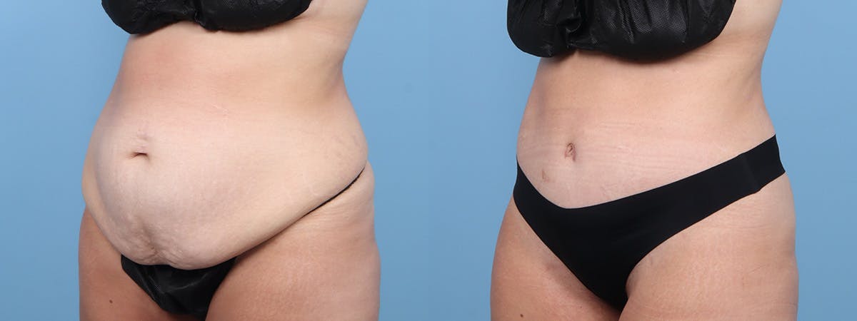 Tummy Tuck Before & After Gallery - Patient 222366 - Image 4