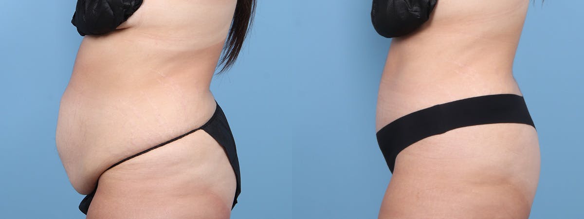 Tummy Tuck Before & After Gallery - Patient 222366 - Image 5
