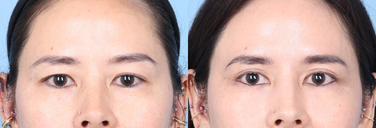 Eyelid Surgery Before & After Gallery - Patient 150179 - Image 1